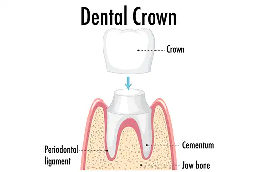 what is dental crown